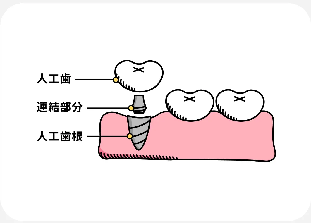 天然の歯と同じように噛める